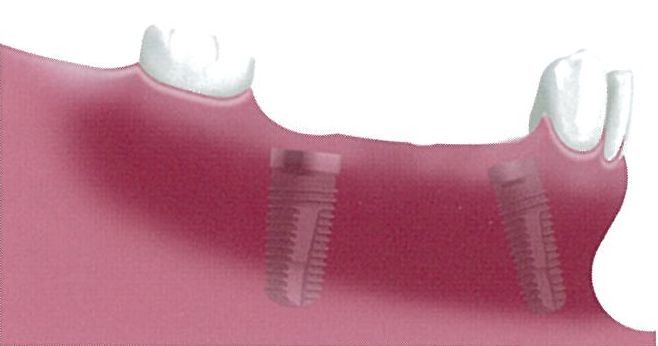 臼歯部で複数の歯が欠損 インプラント