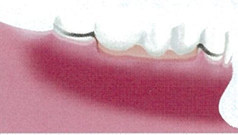 臼歯部で複数の歯が欠損 従来