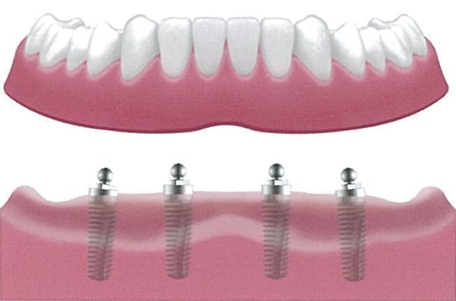 歯が全くない場合 インプラント